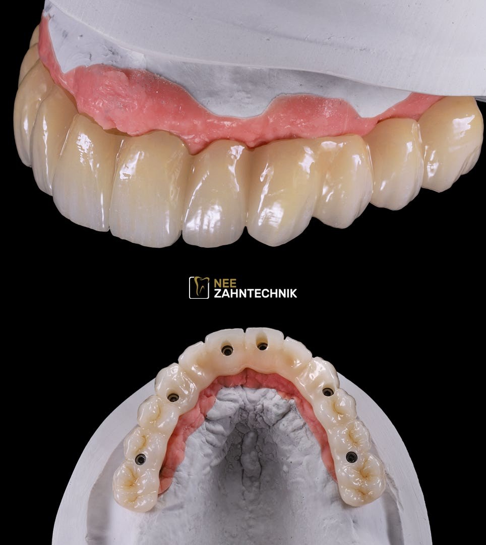 Dentalrestauration aus dem Fachbeitrag über Nee Zahntechnik
